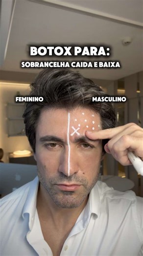 O botox não é apenas sobre suavizar rugas - pode realmente ajudar a moldar as suas características! Ao colocar Botox em áreas selecionadas, podemos destacar e melhorar traços masculinos (como sobrancelhas robustas e retas), ou características femininas (como sobrancelhas elevadas e curvas).
