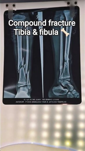 compound fracture tibia and fibula 🦴💀#viral #xray #bone #surgery #shortsfeed #shorts#op #kids #dream