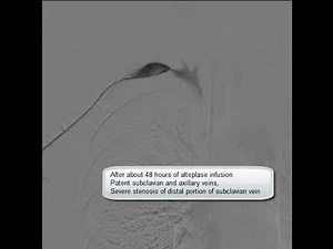 Upper Extremity Deep Vein Thrombosis and Catheter Directed Thrombolysis