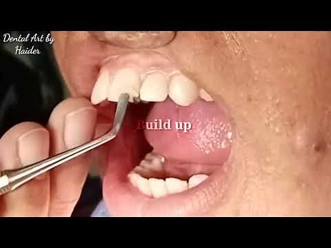 Light Cure Composite Filling || Front teeth filling || Composite Filling Procedure....