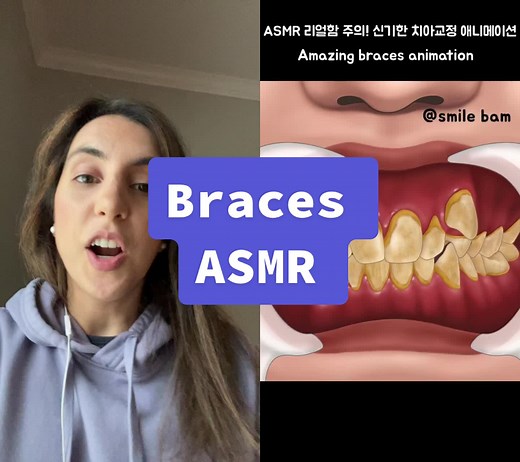 Braces Teeth Process Animation | Learn on TikTok