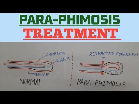 #पैराफिमोसिस का उपचार।