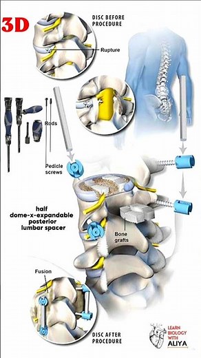 half dome-x-expandable posterior lumbar spacer #youtubeshorts | learn Biology with Aliya