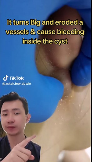 Understanding Cysts: Causes, Treatment, and Prevention