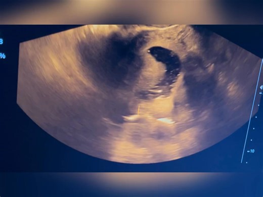 Submucos fibroid in TVS and Saline infusion sonography | Dr Taslima Begum