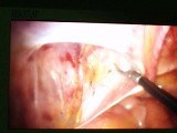 Laparoscopic Inguinal Hernia Repair, TAPP • Video • MEDtube.net