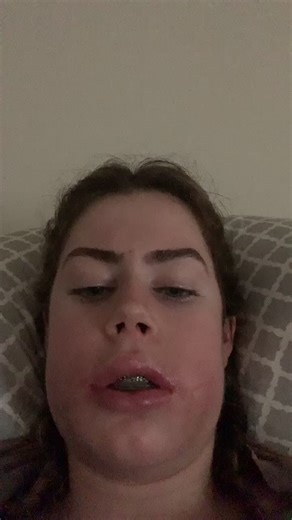 Jaw Surgery Recovery Timeline: 3 Days to 3 Months