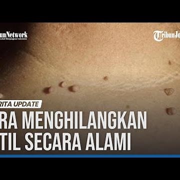 CARA ALAMI UNTUK MENGHILANGKAN KUTIL YANG MEMBANDEL