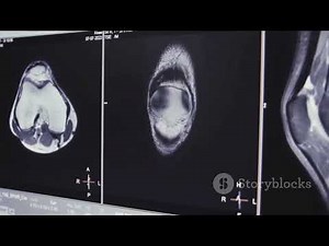 Knee MRI Findings Explained Simply