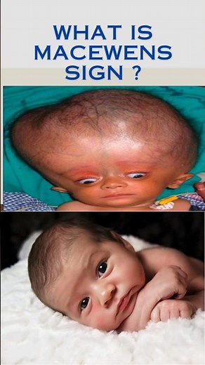 Macewens sign in children / hydrocephalus / nursing exam questions. #shorts #nurses #nursejobs #psc