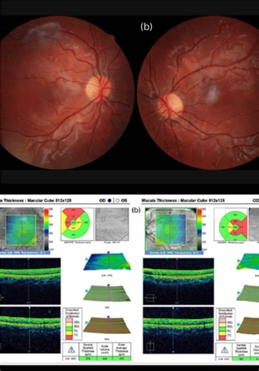 👁️Cinical scenario: An eight-year-old girl presented to the ophthalmology department due to poor vision in both eyes. 🔎Dilated fundus examination indicated the absence of light reflex around the foveal area. 🕵️What's the possible diagnosis? #eyehealth #eyecare #ophthalmology #medtok #retina