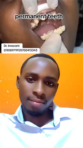 Benefits of Permanent Teeth Replacement Using a Bridge