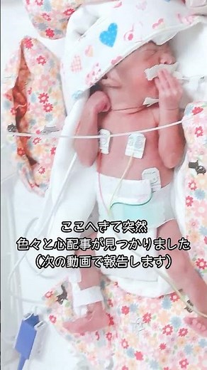 妊娠22週 手のひらサイズで生まれた赤ちゃん 奇跡の成長