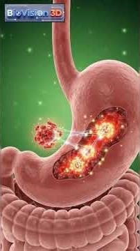Severe Stomach Ulcer Progression | 3D Medical Animation of Gastric Inflammation#3danimation #science