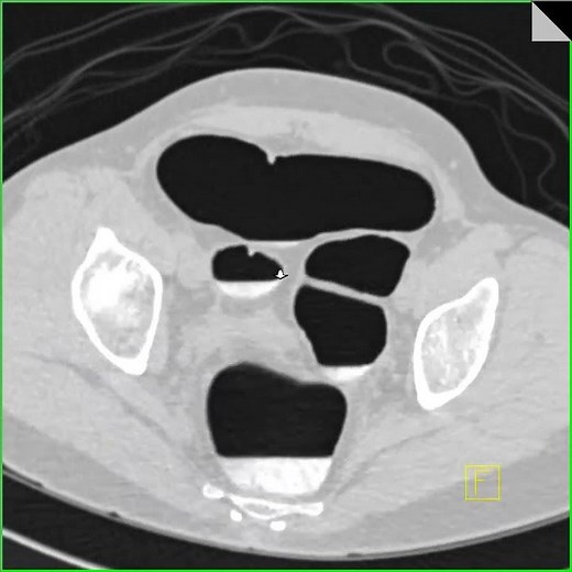 Virtual colonoscopy with retained fluid and stool