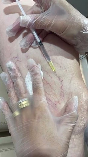 Aplicação em microvasos - PEIM