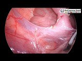 Laparoscopic Appendectomy in Pediatric Patient • Video • MEDtube.net