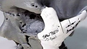 Man Receives Facial Reconstruction With Help From 3D Printer