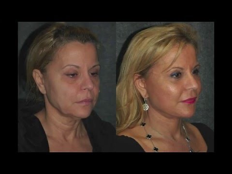 SMAS Facelift Before and After 59 Year Old Woman | #SMASFacelift