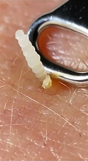 Extreme Pimple Popping & Dermatology Extractions | The Ultimate Satisfying Content() #short #acne