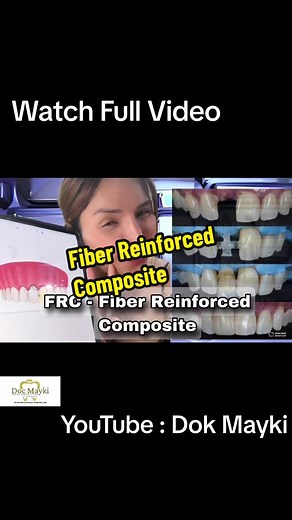 Dok Mayki Dental Clinic: Fiber Reinforced Bridge Treatment