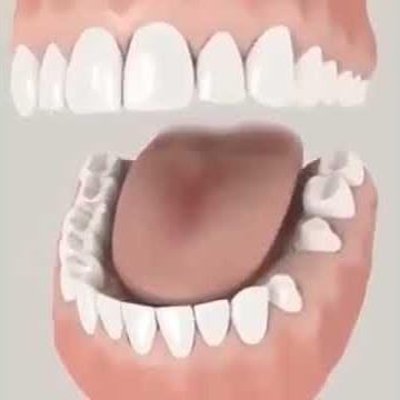 What is a Dental Bridge?