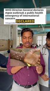 Monkeypox: Symptoms, Transmission, Diagnosis, and Treatment In this video, we discuss the monkeypox virus, which has been declared a disease of international concern by the WHO. We talk about the symptoms of the disease, including fever, headache, body ache, lymphadenopathy, and a characteristic rash. The mode of transmission is through direct skin-to-skin contact, and the reservoir is still unknown, but could potentially be squirrels. The diagnosis is made through PCR testing, and the treatment