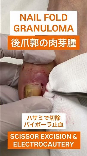 後爪郭の肉芽腫の処置動画