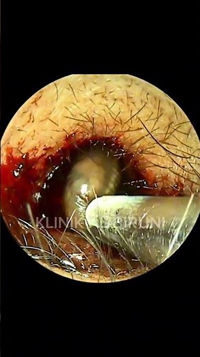 Bloody LEECH Found Inside The Ear