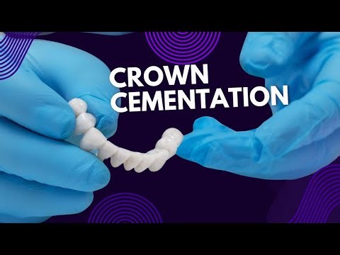 Crown Cementation- With Tight Contacts And Without High Points.