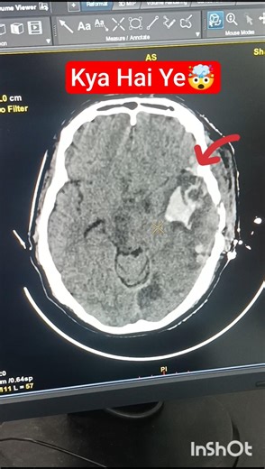 CT Scan Shock 😳 Brain Bleed + Skull Fracture Ek Saath Kaise Dikha?#radiology #trending #doctor#viral