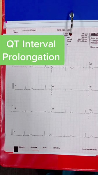 Understanding QT Interval Prolongation in Cardiology