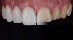 Smile Make Over Changing Yellow Teeth Stock Footage Video (100% Royalty-free) 1076472269 | Shutterstock