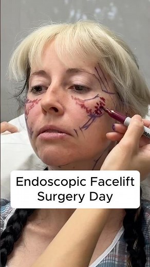 Endoscopic Deep Plane Facelift At 42 - Surgery Day #facelift
