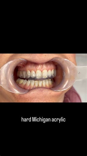 Dr Alisa Botbol on Instagram: "🦷 Occlusion in motion 🎥 This video demonstrates a michigan occlusal splint/bite plate in function. The appliance is designed with a clinical prescription to the technician to include some key occlusal factors: 🔑 using a mutually protected occlusal scheme 🔑 Canine guidance which guides lateral (excursive) movements, this results in disclusion of the posterior teeth to reduce lateral loading forces. 🔑 Anterior guidance during protrusive movement, which protects 