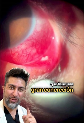 Concreciones Cálcicas Conjuntivales: Causas y Tratamientos