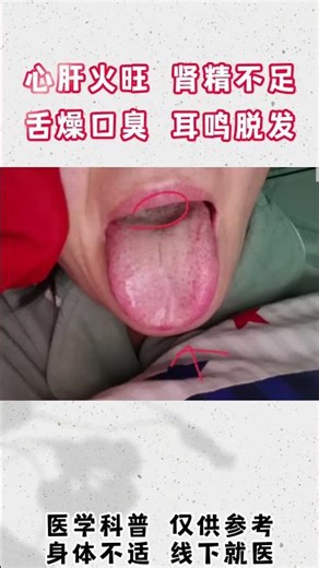 2023年10月19日 舌诊分析——心肝火旺，肾精亏虚，舌燥口臭，腹胀 耳鸣,健康养生,中医药