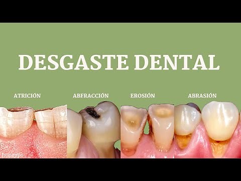 Desgaste dental : atrición, abfracción , erosión y abrasión