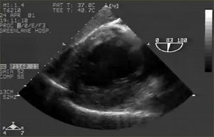 4 comments | This patient had Left coronary artery occlusion a.Possibly b.Never c.Can't comment Anteromedial papillary muscle of Mitral valve is prone to rupture? a.Never b.Often c.sometimes | Cardiology-Dr.AsifUllah | Facebook