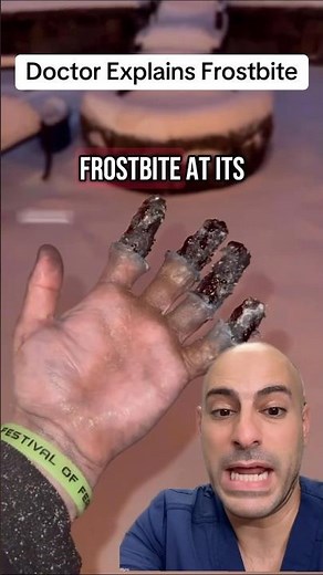 Doctor Explains FROSTBITE