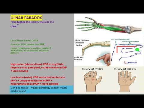 Ulnar paradox explained in less than 3 minutes.