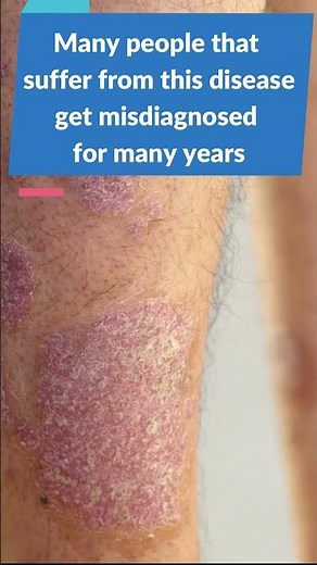 Can Psoriasis cause Arthritis? Learn about Psoriatic Arthritis!