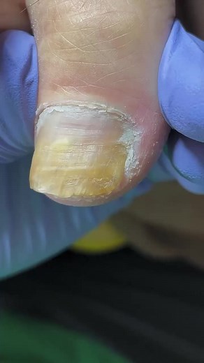 #toenail | Ingrown Toenails