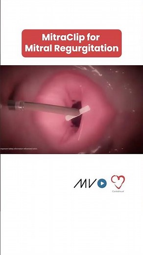 Transforming Mitral Regurgitation Management with MitraClip | Cardiology Education