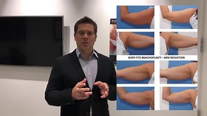 Bodytite treatment for Recontouring Arms, Knees, Abdomens, and Backs