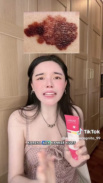 Bahaya Nevus: Kenali dan Cegah Kanker Kulit