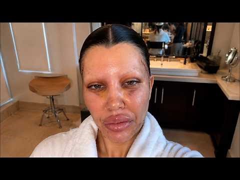 100+ Celebs Who Got UGLY After This NEW Plastic Surgery Trend