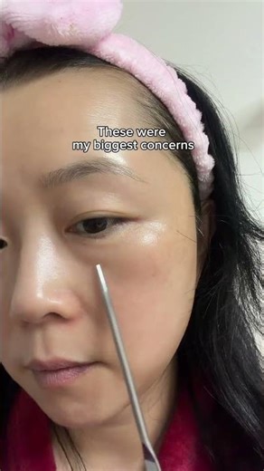 Botox at Home? Gold Peptide Threads for Lifting ✨