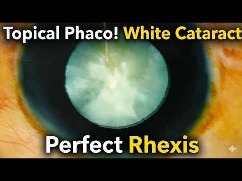 Topical Phaco in White Cataract: Safe Capsulorhexis & Foldable IOL Implantation