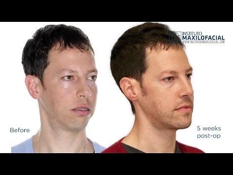 Orthognathic bimaxillary surgery. Case # 66: Daniel- Maxillomandibular retrusion, facial assymetry